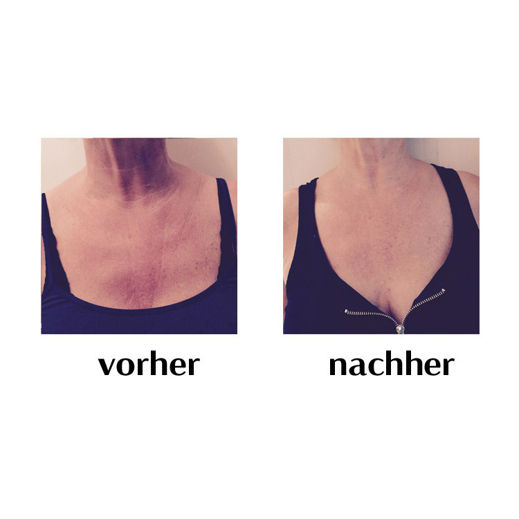 Anti-Falten Dekolleté Pad - Wonderstripes